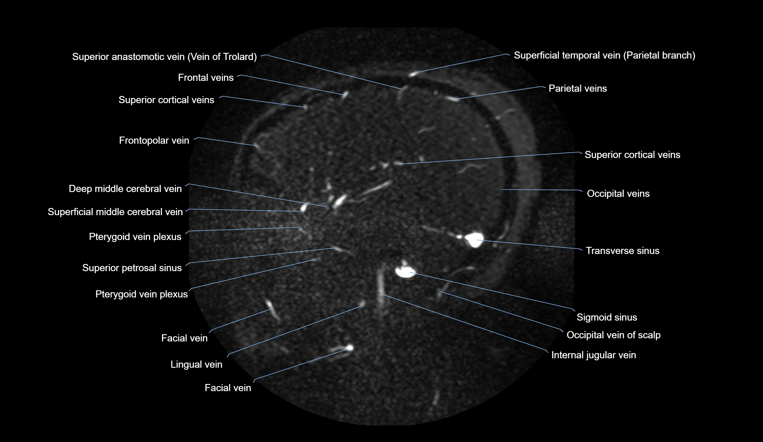 MRV brain sagittal anatomy 3T MRI images -img-01015-00024.webp